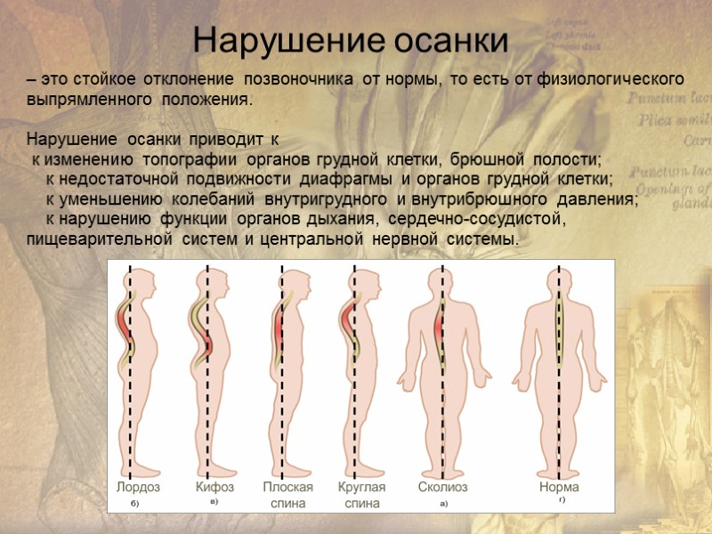 Нарушение осанки – это стойкое отклонение позвоночника от нормы, то есть от физиологического выпрямленного